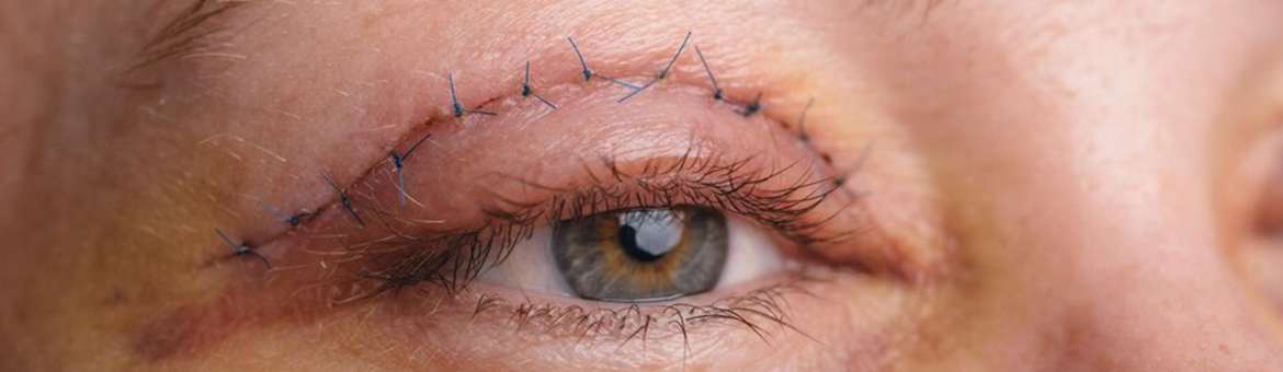 Пластика век (блефаропластика)