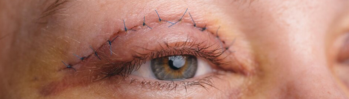 Пластика повік (блефаропластика)