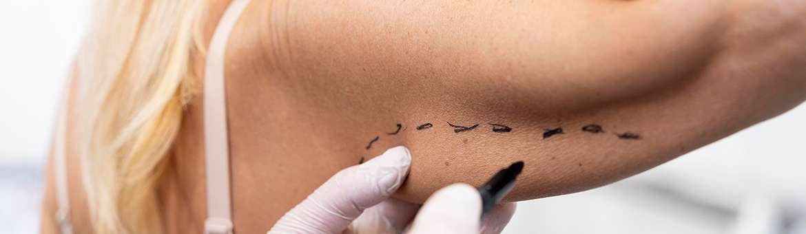 Пластика рук (брахіопластика)