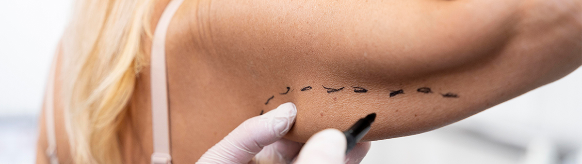 Пластика рук (брахіопластика)