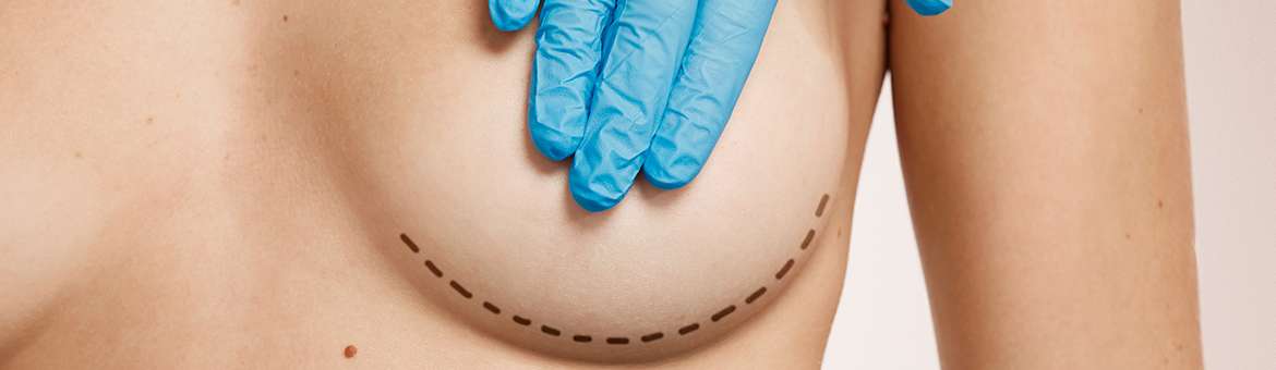 Збільшення грудей (мамопластика)