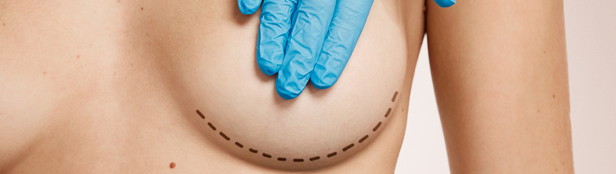 Збільшення грудей (мамопластика)