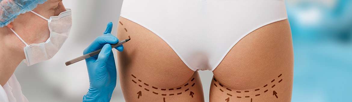 Ліпофілінг тіла