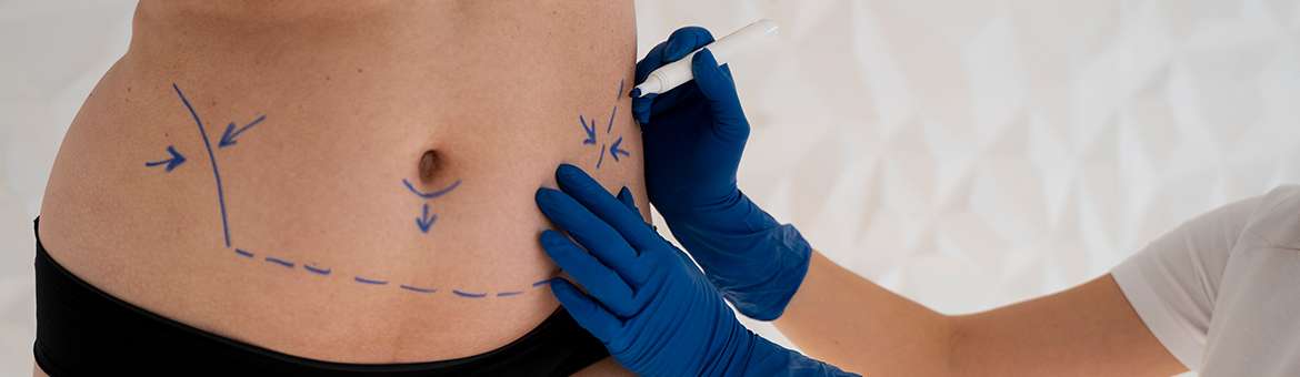 Ліпосакція