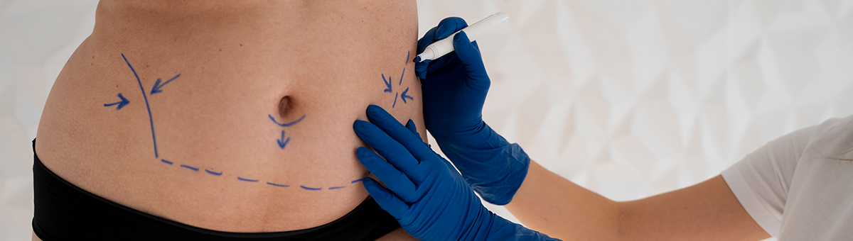 Ліпосакція