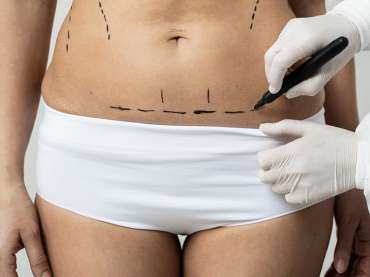 Абдомінопластика: як проходить операція з підтяжки живота та кому вона підходить