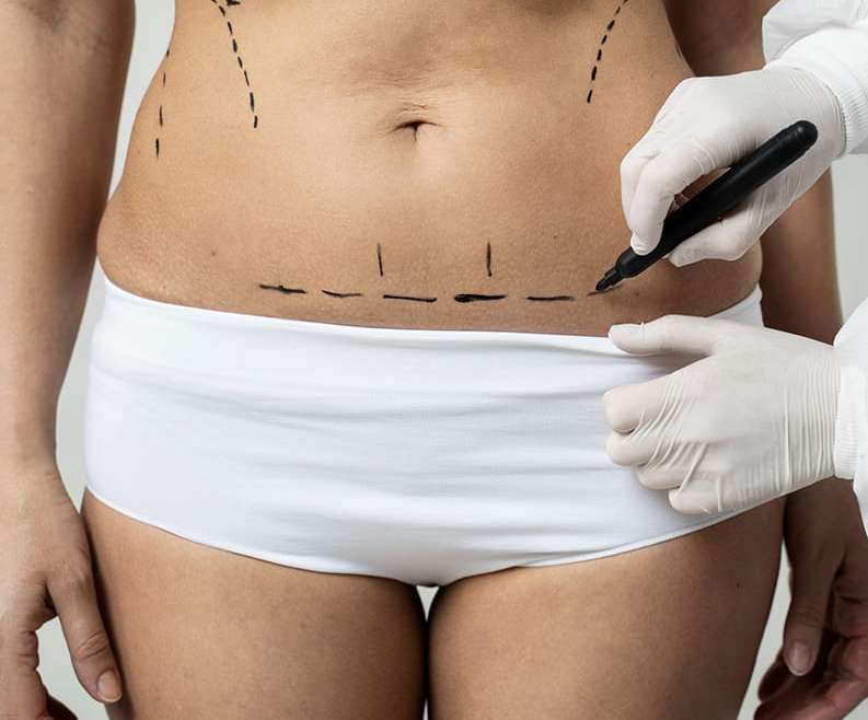 Абдомінопластика: як проходить операція з підтяжки живота та кому вона підходить
